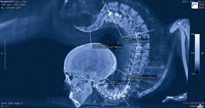 athlete's x-ray