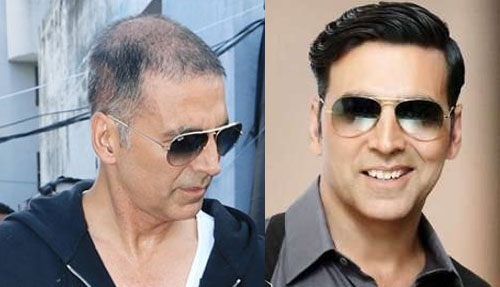 5 Bollywood Celebrities Whose Career Changed After Getting Hair Transplant