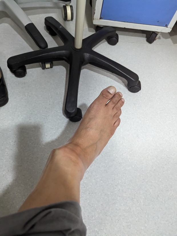 indigo passenger ankle injury