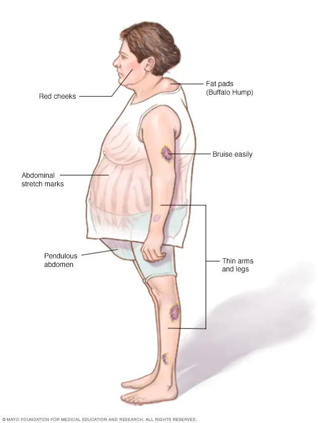Cushings syndrome